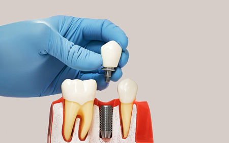 Dental Implants at Harmony Dental ,Pearland,TX